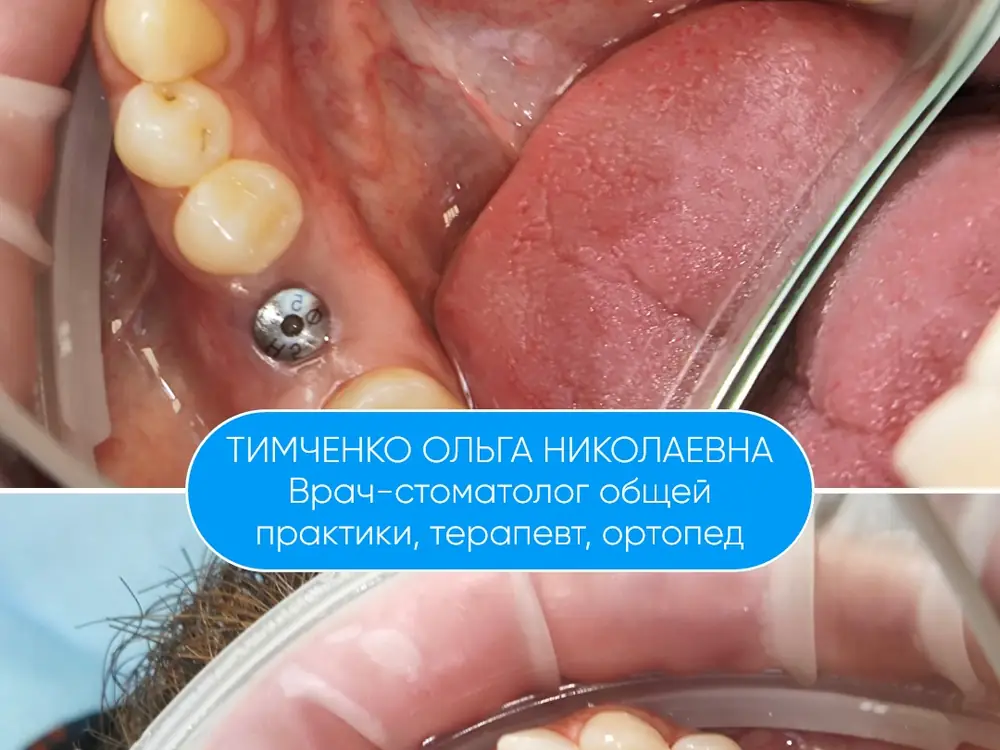 Снимок с внутриротовой камеры на экране